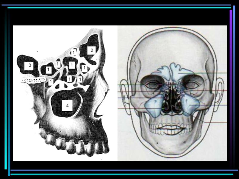 Пазухи черепа. Околоносовые пазухи аномалии. Пазуха верхней челюсти на черепе.