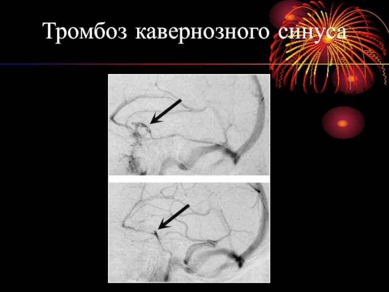 Тромбоз кавернозного синуса фото