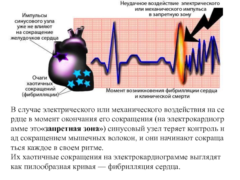 Зона импульса. Фибрилляция сердца. Трепетание желудочков на ЭКГ. Фибрилляция желудочков сердца. Фибрилляция сердца относится к.