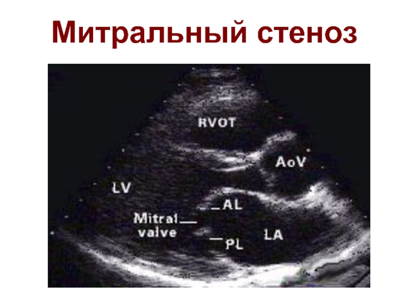 Митральный аортальный стеноз. Стеноз митрального клапана на ЭХОКГ. Стеноз митрального клапана на УЗИ. Aortal stenoz exokardiographia. Митральный стеноз критерии ЭХОКГ.