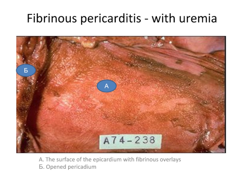 Fibrinous pericarditis - with uremia