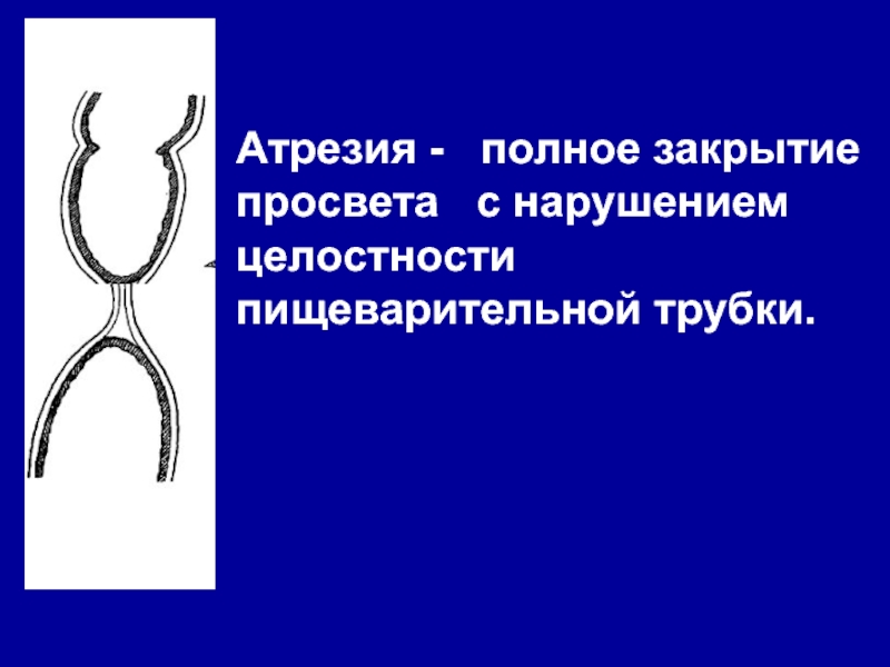 Низкая атрезия. Атрезия пищевода у детей презентация. Атрезия пищевода у новорожденных.