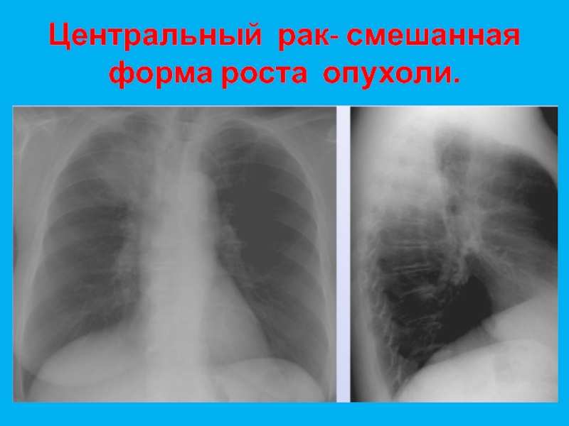 Центр легких. Злокачественные опухоли легких названия. Опухоль в s8 легкого. Центральный рак?. Злокачественная смешанная.