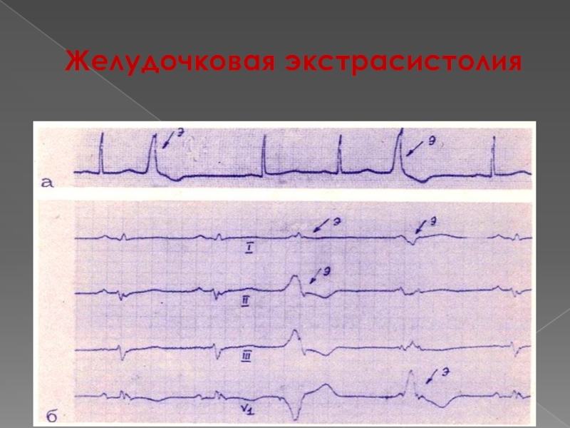 Желудочковая экстрасистолия фото