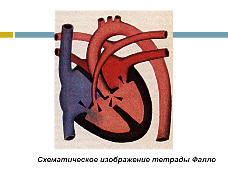 Тетралогия Фалло. Тетрада Фалло рисунок. Тетрада Фалло классификация. Операция при тетраде Фалло.