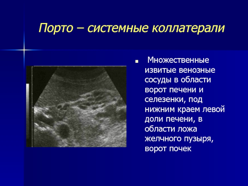 Сосудистый рисунок печени. Коллатерали воротной вены печени. Портальная гипертензия на УЗИ. Коллатерали в воротах в печени.