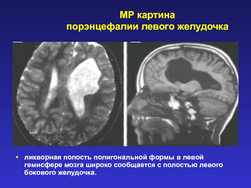 Порэнцефалическая киста