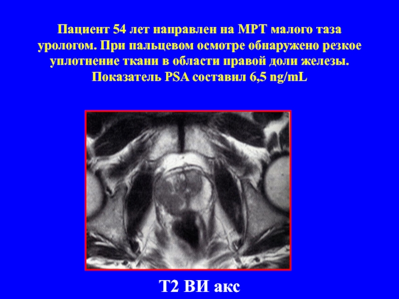 Пациент 54 лет направлен на МРТ малого таза урологом. При пальцевом осмотре