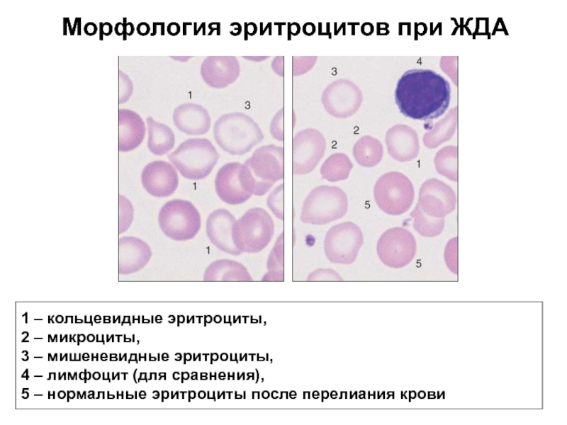 Картина крови при жда