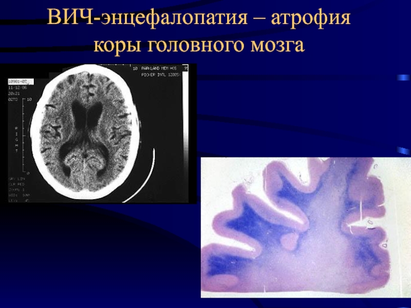 Атрофия презентация патология