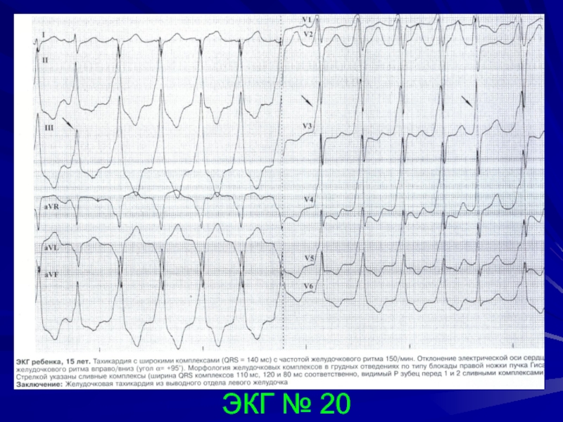 Сливной экс. Сливные комплексы на ЭКГ при парасистолии. Сливные желудочковые комплексы на ЭКГ С экс. Сливные и псевдосливные комплексы с экс. Сливные комплексы на холтеровское мониторирование.