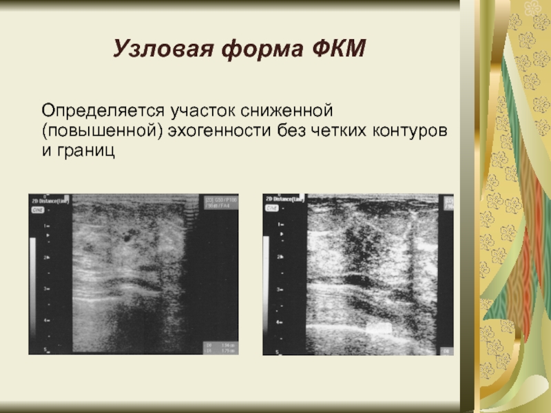 Узи молочной железы фкм. УЗИ Узловая фиброзно-кистозная мастопатия. Узловая форма фиброзно-кистозной мастопатии на УЗИ. Узловая мастопатия на УЗИ молочной железы. Фиброзно кистозная мастопатия молочной железы на УЗИ.