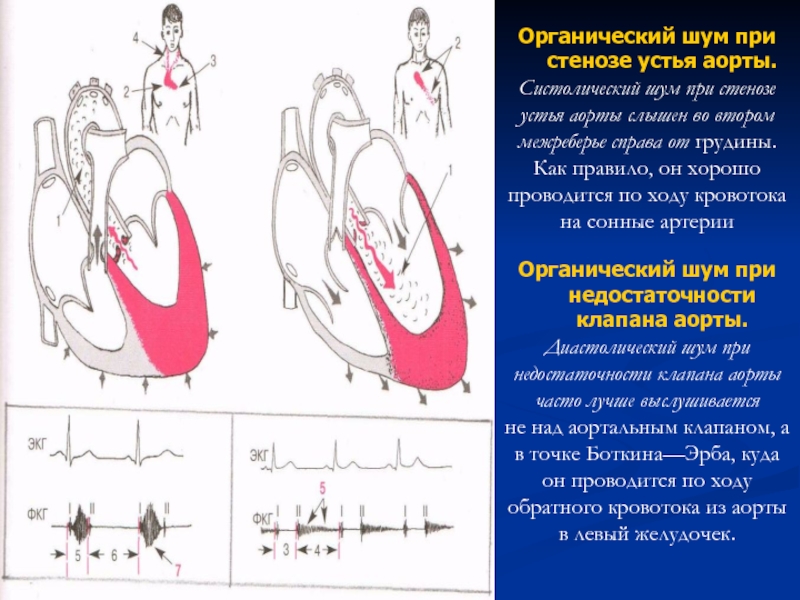 Аускультативная картина аортального стеноза