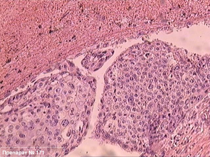 Эпителиальные опухоли. Эпителиальные опухоли патологическая анатомия. Гистология доброкачественные эпителиальные опухоли. Злокачественная эпителиальная опухоль стромы. Доброкачественная опухоль эпителиальной ткани.