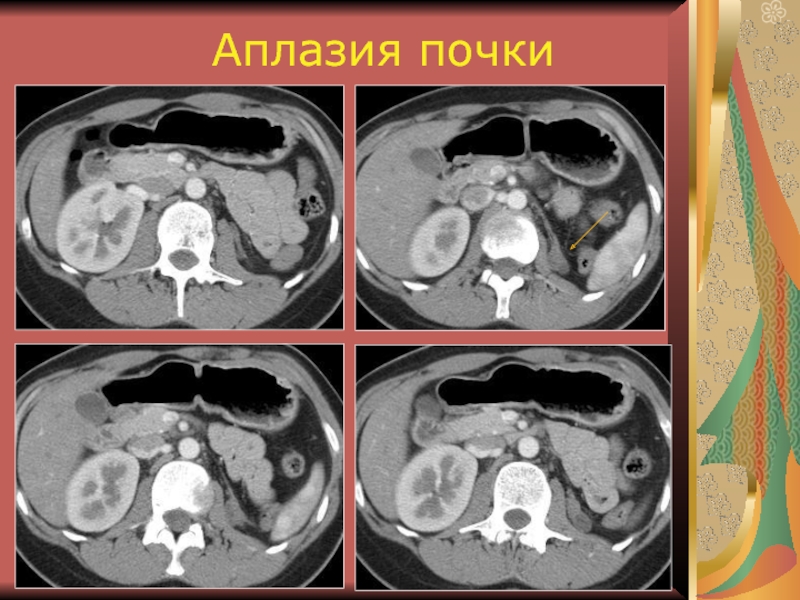 Дисплазия почки презентация