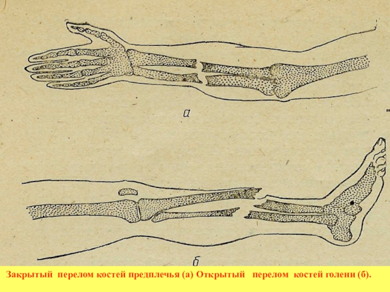 Рисунок перелома кости. Открытый перелом кости. Закрытый перелом костей.