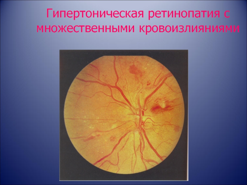 Гипертоническая ангиопатия обоих глаз. Гипертензивная ретинопатия. Гипертоническая ангиопатия сосудов. Ангиоспастическая ретинопатия. Гипертоническая ретинопатия 1 степени.