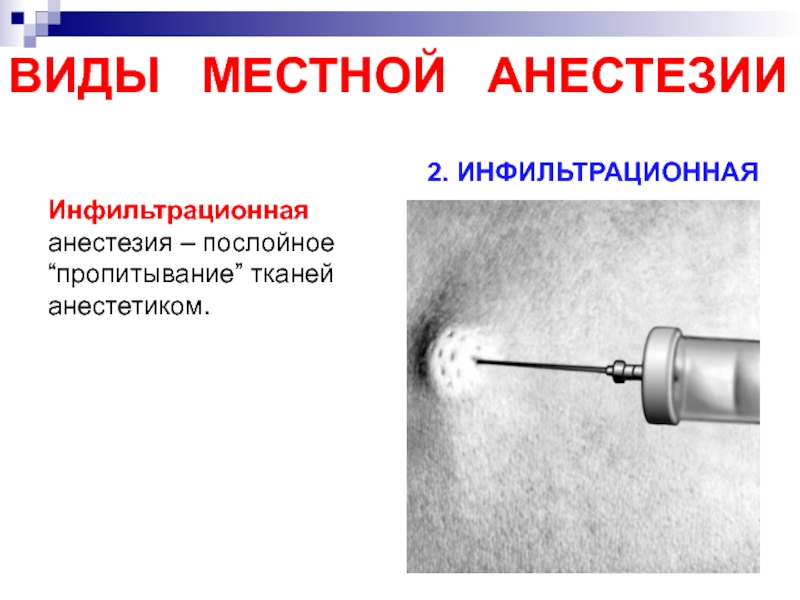 Местное обезболивание. Инфильтрационная анестезия в стоматологии классификация. Терминальная проводниковая и инфильтрационная анестезия. Инфильтрационная анестезия Орлову 1887. Местное обезболивание инфильтрационная анестезия.