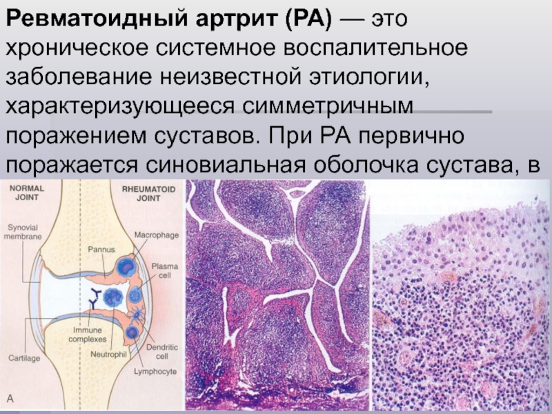 Ревматоидный артрит патанатомия презентация