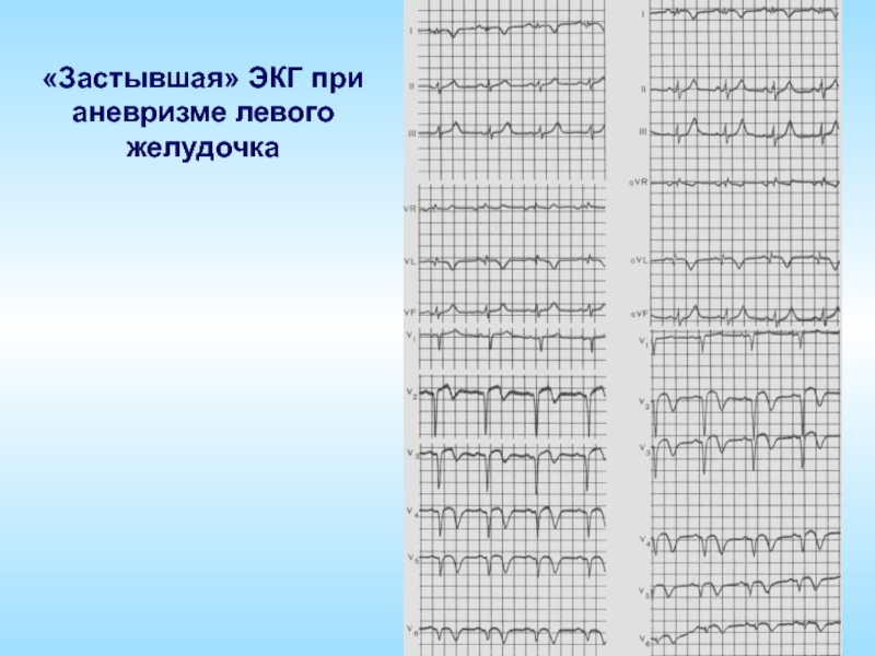 Изменение передней стенки левого желудочка. Аневризма левого желудочка на ЭКГ. ЭКГ при постинфарктной аневризме. Постинфарктная аневризма сердца ЭКГ. Постинфарктная аневризма на ЭКГ.