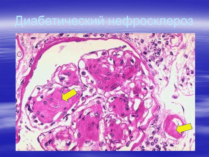 Артериолосклеротический нефросклероз микропрепарат рисунок