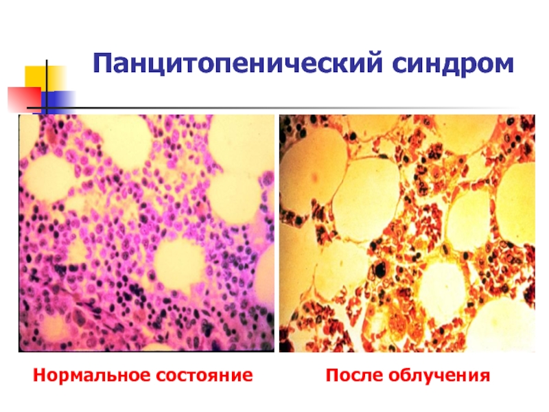 Панмиелофтиз картина крови