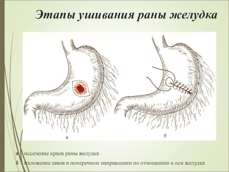Этапы ушивания раны желудкаа – иссечение краев раны желудкаб – наложение швов в поперечном направлении по отношению