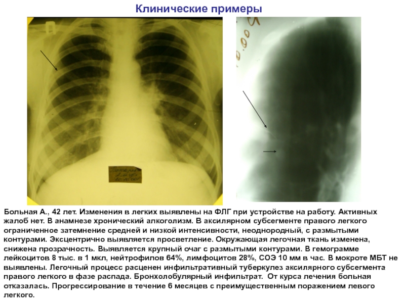 Легко выявляемые. Инфильтративный туберкулез верхней доли левого легкого. Изменения при туберкулёзе на ФЛГ. Инфильтративный туберкулез легких презентация.