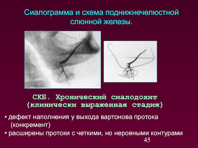 Заболевания слюнных желез у детей презентация