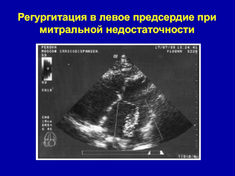 Аускультативная картина митральной недостаточности тест с ответами