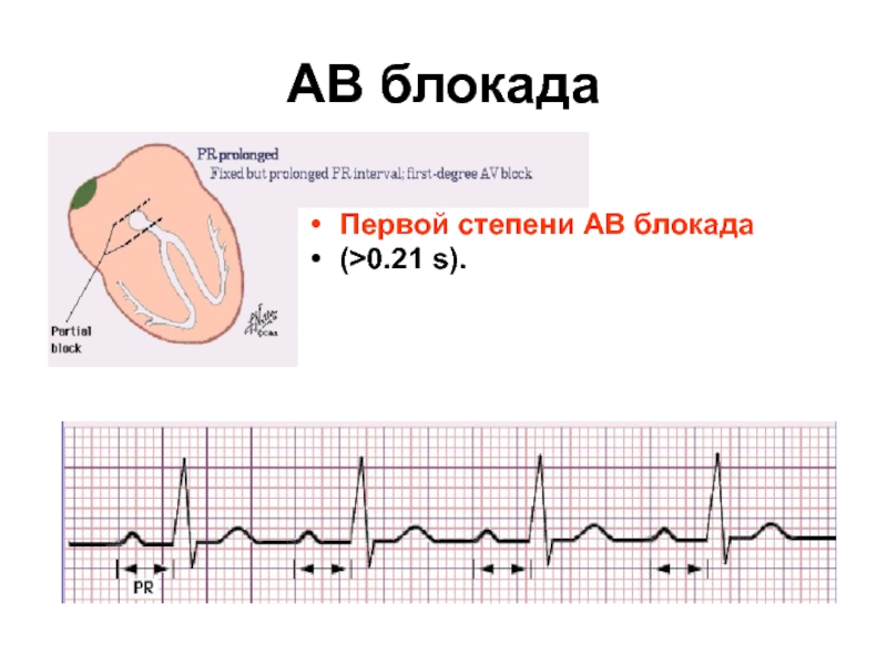 Ав блокада 1. Аве блокада сердца 1 степени. АВ-блокада 1 степени сколько клеток. АВ-блокада 1 степени что у собаки. АВ-блокада 1 степени ХСН 0.