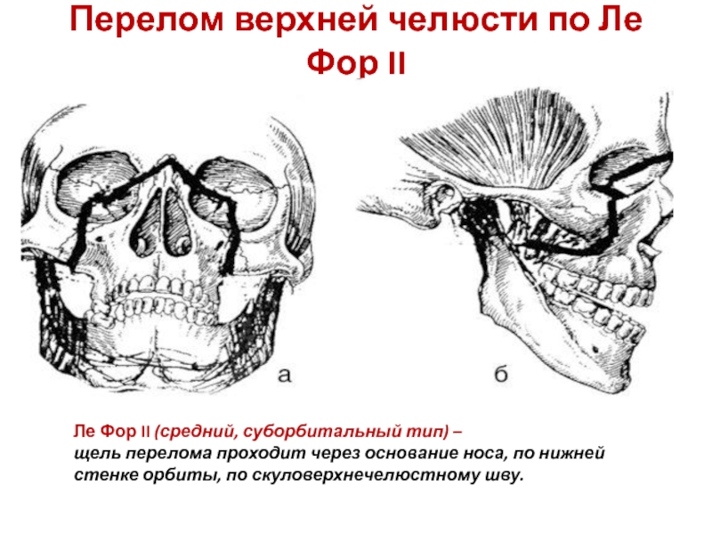 Перелом верхней челюсти по Ле Фор II  Ле Фор II (средний, суборбитальный тип) – щель перелома