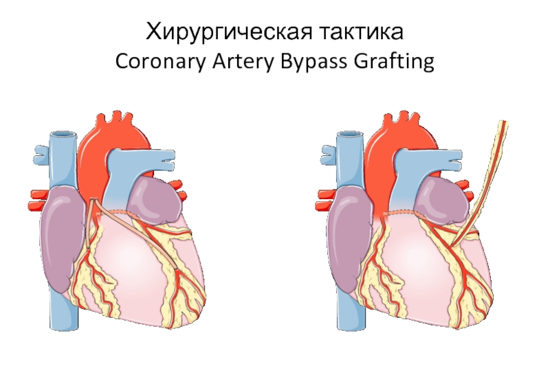 Шунтирование сердца при инфаркте