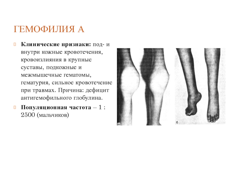 Признаки под. Гемофилия петехиальная сыпь. Гемофилия клиническая картина. Гемофилия клинические проявления.