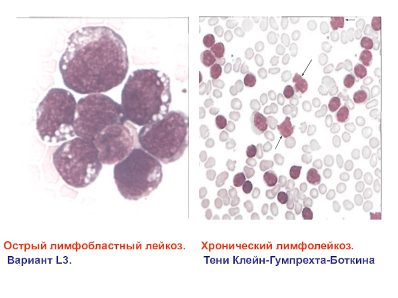 Лимфобластный лейкоз. Клетки Боткина Гумпрехта острый лейкоз. Тени Боткина Гумпрехта. Тени Боткина-Гумпрехта при хроническом лимфолейкозе это. Тени Боткина-Гумпрехта встречаются.