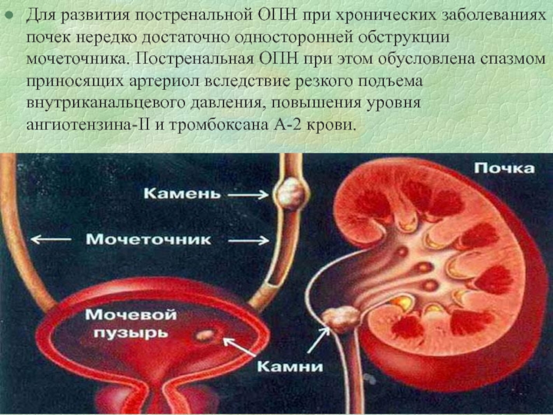 Мочекаменная болезнь патофизиология презентация