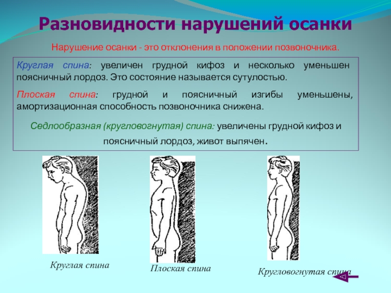 Вертикальное положение позвоночника. Плоская спина. Нарушение осанки плоская спина. Нарушение осанки круглая спина. Плоская спина характеризуется.