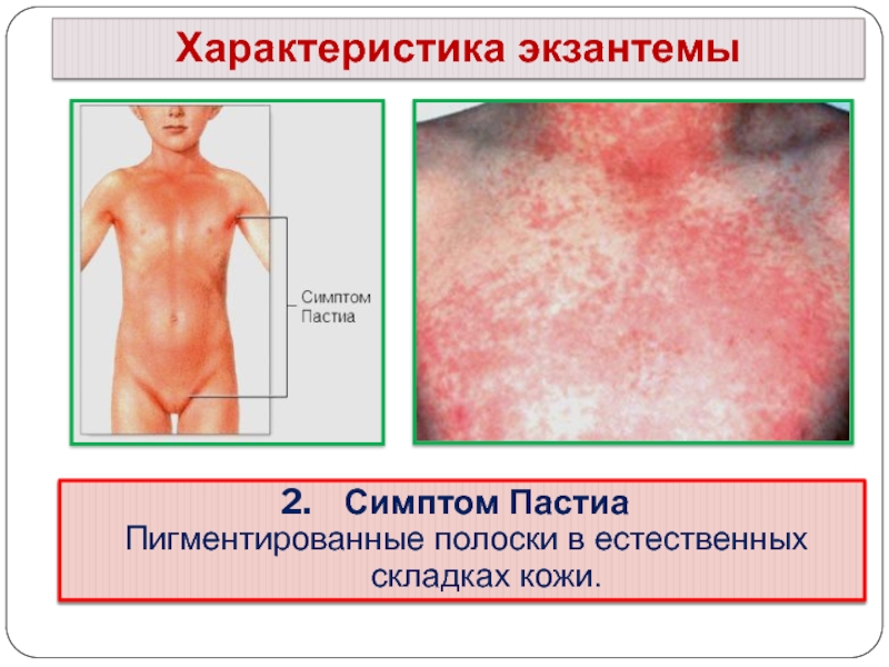 Характеристика экзантемыСимптом Пастиа Пигментированные полоски в естественных складках кожи.