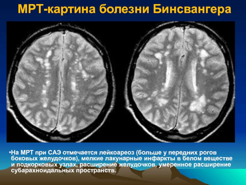 Лакунарная деменция. Лейкоареоз на кт. Лейкоареоз головного мозга мрт. Лейкоареоз RN. Мультифокальная лейкоэнцефалопатия мрт.