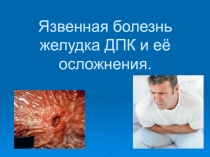Язвенная болезнь желудка ДПК и её осложнения