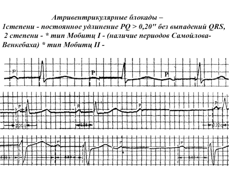 Холтер блокада 1 степени