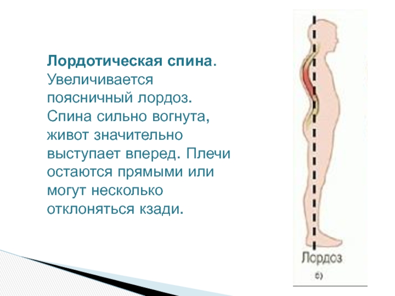 Лордоз поясничного отдела. Поясничный лордоз. Лордотическая осанка. Лордоз прямой поясницы. Измерение угла поясничного лордоза.