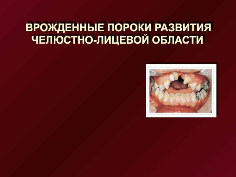 ВРОЖДЕННЫЕ ПОРОКИ РАЗВИТИЯ
ЧЕЛЮСТНО-ЛИЦЕВОЙ ОБЛАСТИ