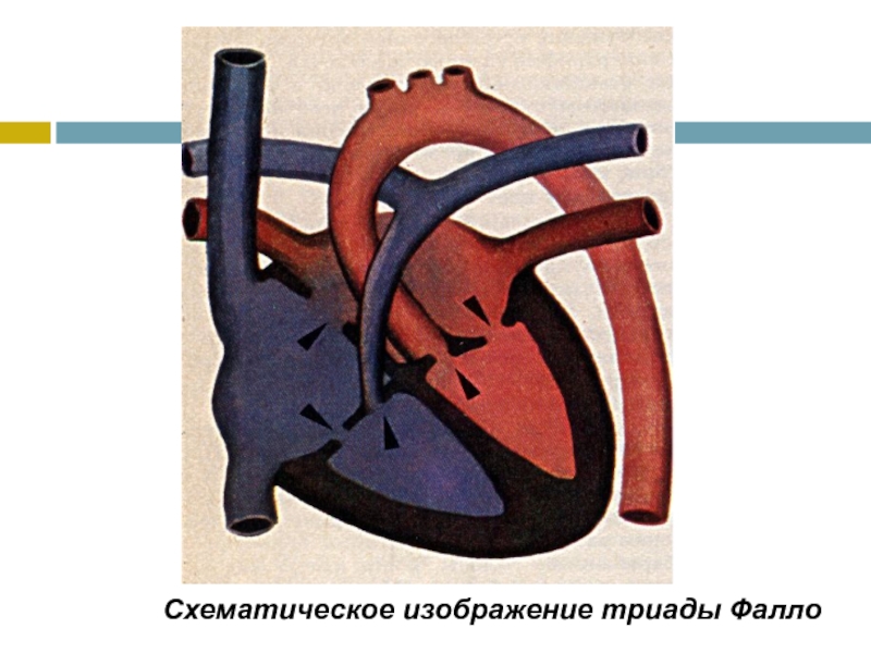 Триада фалло презентация