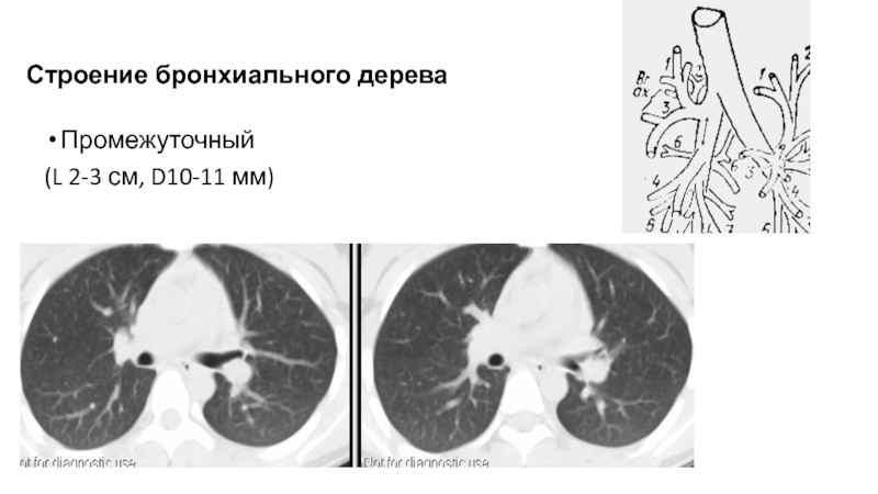 Бронхи на кт схема