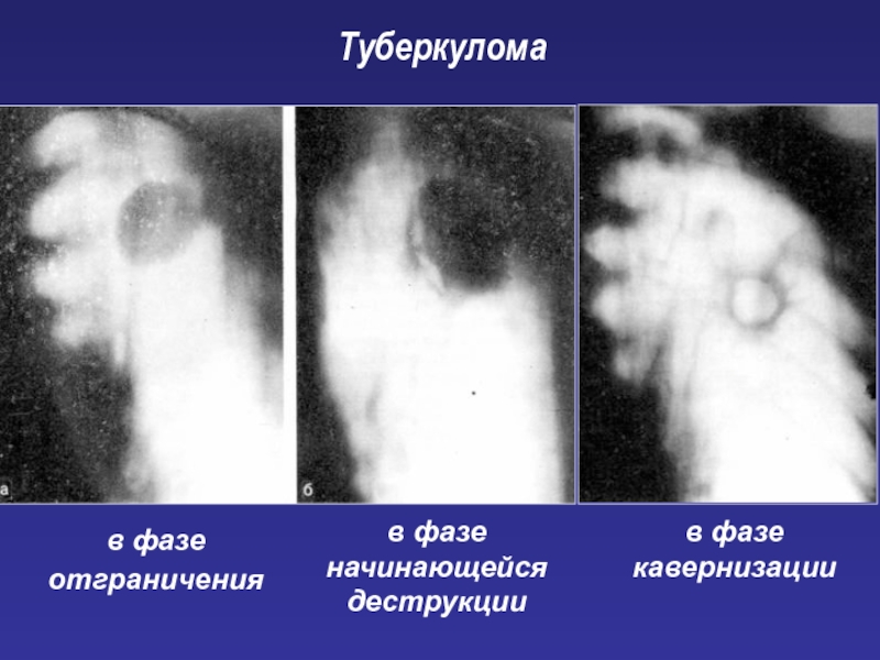 Туберкулома. Конгломератная туберкулома. Туберкулома рентген. Туберкулома в фазе распада. Туберкулома рентген признаки.