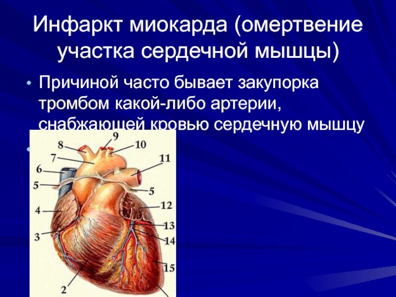 Инфаркт миокарда (омертвение участка сердечной мышцы)Причиной часто бывает закупорка тромбом какой-либо артерии, снабжающей кровью сердечную мышцу