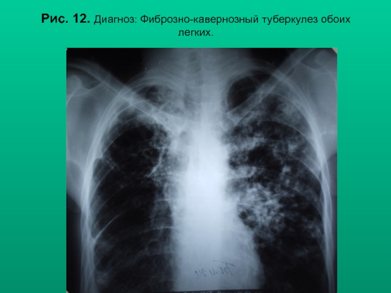 Диагноз 12 4. Фиброзно-кавернозный туберкулез легких диагноз. Фиброзно-кавернозный туберкулез рентген. Кавернозный туберкулез диагноз. Кавернозный туберкулез легких презентация.