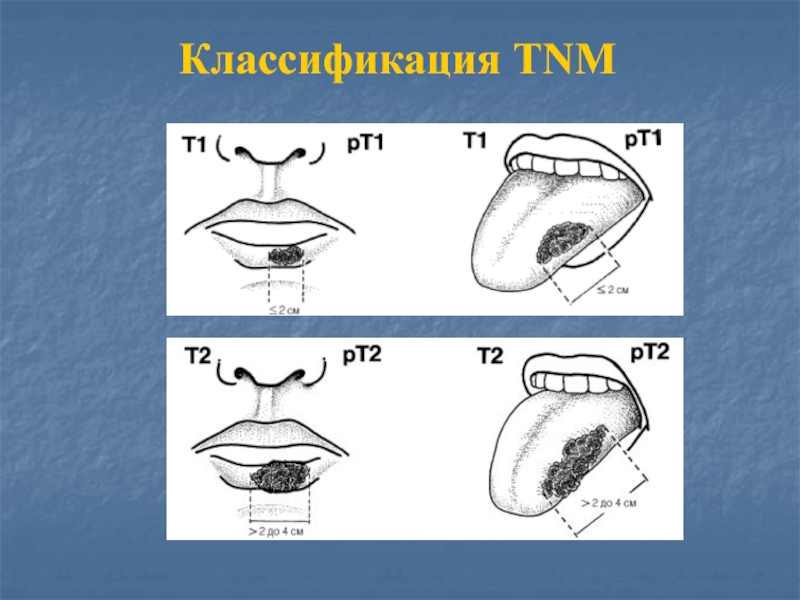 Доброкачественные опухоли челюстно лицевой области классификация презентация