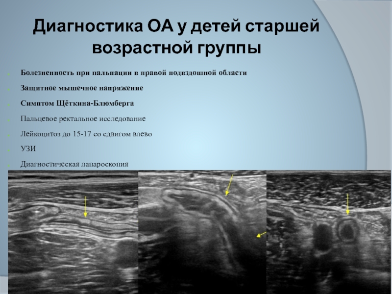 Презентация аппендицит у детей